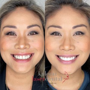 KLDFA Gum Lift Teeth Whitening