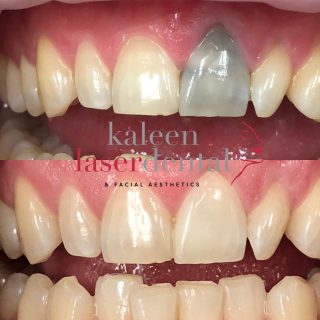 Teeth whitening before after treatment