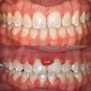 KLDFA LASER GUM LIFT